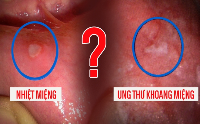 Nhiệt miệng và ung thư miệng.